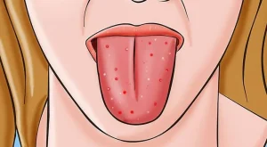 Dilde uçuk neden çıkar Nasıl geçer ?